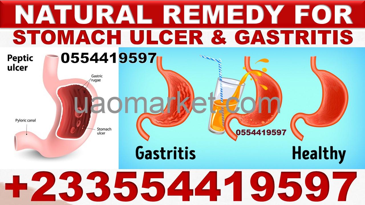 HERBAL SUPPLEMENTS FOR STOMACH ULCER OR GASTRITIS ULCER